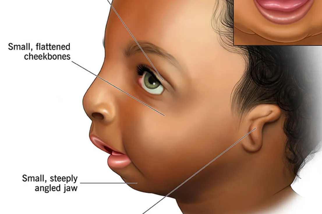 ML in Rare Facial Disorders: Hemifacial Microsomia, Parry–Romberg Syndrome, Moebius Syndrome, Treacher Collins Syndrome, Apert Syndrome, and Crouzon Syndrome-From Etiological Mapping and Pathology to AI-Driven Bio-Computational Gene Therapy - Issue cover