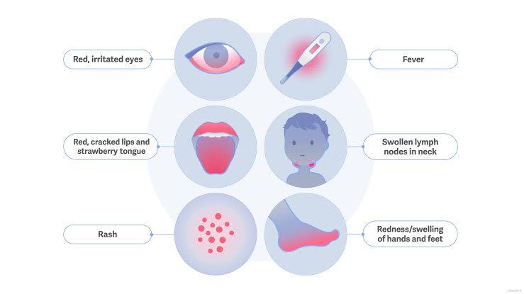 Kawasaki Disease “Unmasked”: A Case Study from Fever to Full Recovery - Issue cover