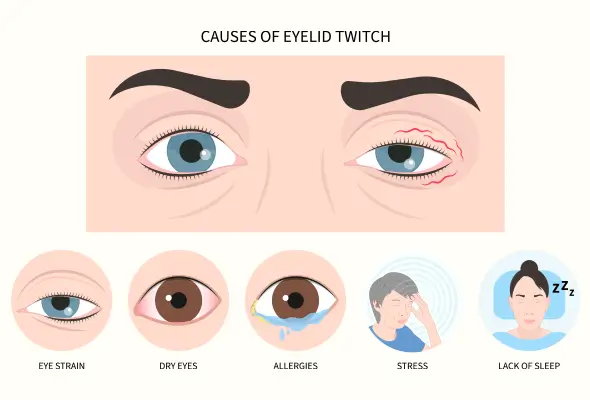 Eye spasm/Eye twitching: Mg Supplementation and Stress-Reduction in Treating Eyelid Myokymia, Psychosomatic of Anxiety:  of Eye Twitching Among High-Stress, Hemifacial Spasm,Blepharospasm - Issue cover